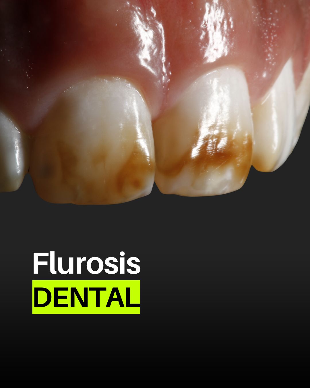flurosis dental
